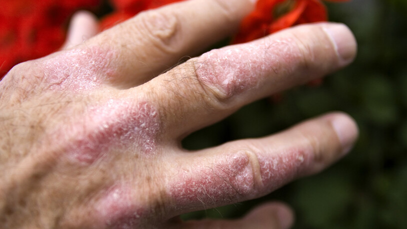 Schuppenflechte (Psoriasis) an der Hand eines Mannes: Medikamente gegen die Hautkrankheit, die den Botenstoff Interleukin-12 blockieren, sind wohl kontraproduktiv, wie eine neue Studie zeigt. (Archivbild)