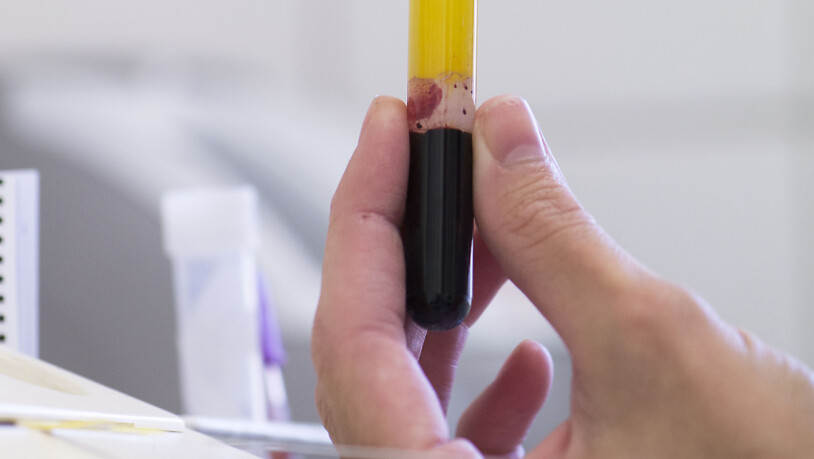 Anhand eines Proteins im Blut lässt sich der zu erwartenden Krankheitsverlauf und die Wirksamkeit einer Therapie bei Multipler Sklerose abschätzen. (Symbolbild)