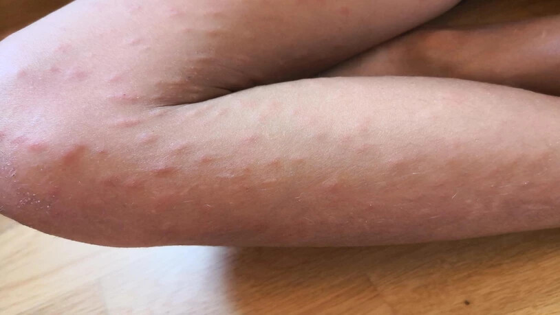 Entenflöhe lösten die allergische Reaktion bei den Kindern aus.