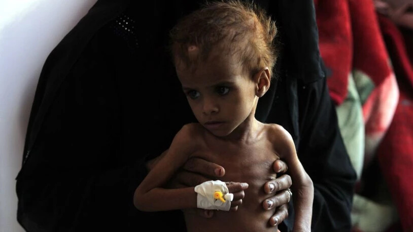 Ein jemenitisches Kind wird wegen Unterernährung in einem Spital in Sanaa behandelt. (Archivbild)