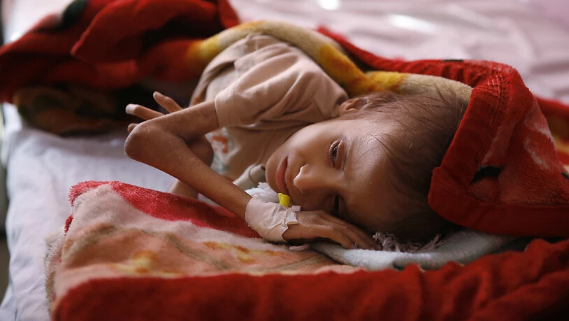Ein unterernährtes Kind in einem Spital in der jemenitischen Hauptstadt Sanaa. (Archivbild)