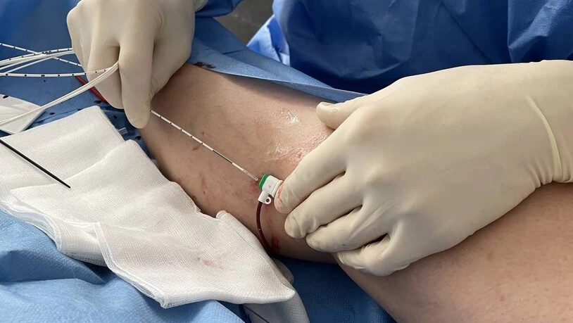 Operative Behandlung von Krampfadern (endovenöse Laserablation).