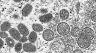 HANDOUT - Diese elektronenmikroskopische Aufnahme aus dem Jahr 2003, die von den Centers for Disease Control and Prevention zur Verfügung gestellt wurde, zeigt reife, ovale Affenpockenviren (l) und kugelförmige unreife Virionen (r). Foto: Cynthia S…